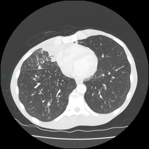 Acute right lung abscess (Radiopaedia 34806-36258 Axial lung window 130).jpg