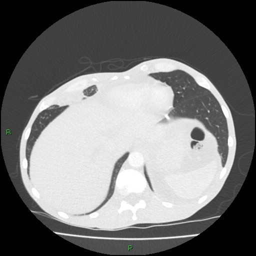 File:Acute right lung abscess (Radiopaedia 34806-36258 Axial lung window 161).jpg