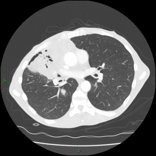 File:Acute right lung abscess (Radiopaedia 34806-36258 Axial lung window 96).jpg