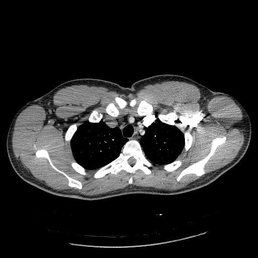 Acute segmental pulmonary emboli and pulmonary infarction (Radiopaedia 62264-70444 Axial C+ CTPA 26).jpg