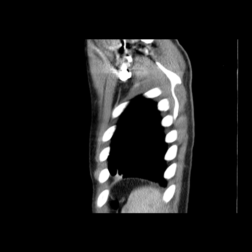 File:Acute segmental pulmonary emboli and pulmonary infarction (Radiopaedia 62264-70444 Sagittal C+ CTPA 58).jpg