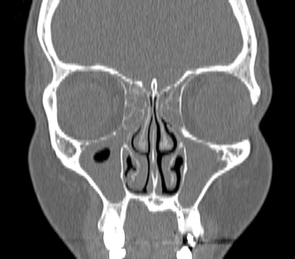 Acute sinusitis (Radiopaedia 40564-43158 Coronal bone window 13).jpg