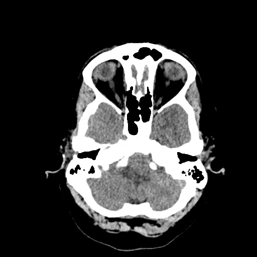 Acute subarachnoid hemorrhage and accessory anterior cerebral artery (Radiopaedia 69231-79008 Axial non-contrast 11).jpg