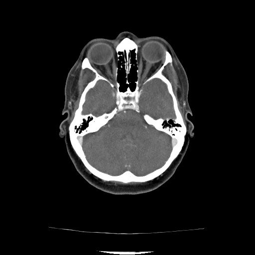 Acute subarachnoid hemorrhage and accessory anterior cerebral artery (Radiopaedia 69231-79009 Axial C+ arterial phase 86).jpg