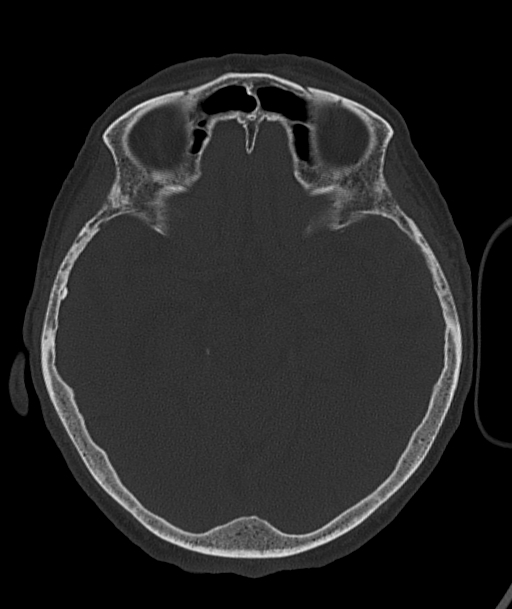 Acute traumatic subdural hematoma (Radiopaedia 82921-97257 Axial bone window 66).jpg