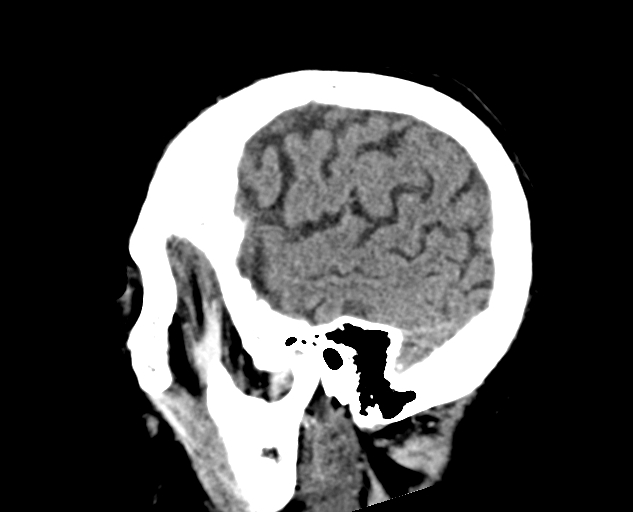 Acute traumatic subdural hematoma (Radiopaedia 82921-97257 Sagittal non-contrast 18).jpg