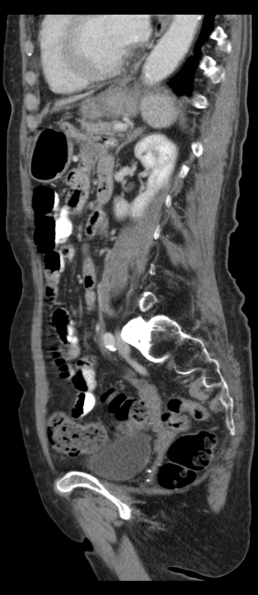 Adenocarcinoma of cecum (Radiopaedia 59222-66549 Sagittal C+ portal venous phase 32).jpg