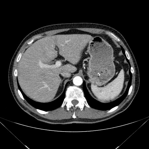 File:Adenocarcinoma of the lung (Radiopaedia 59871-67325 Axial C+ arterial phase 89).jpg