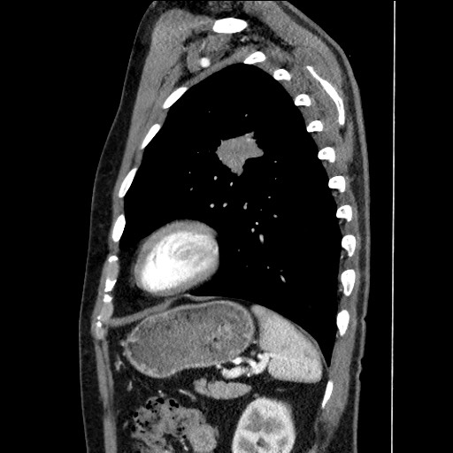 Adenocarcinoma of the lung (Radiopaedia 59871-67325 Sagittal C+ arterial phase 79).jpg