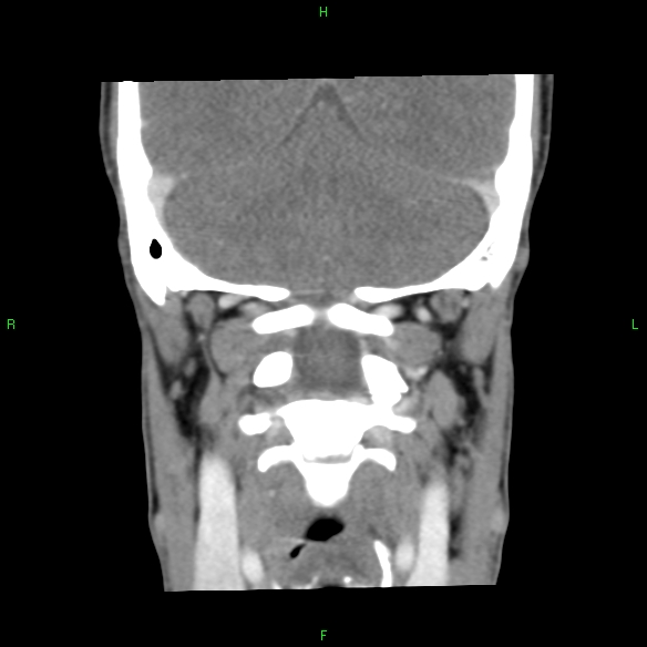 File:Adenoid cystic carcinoma of hard palate (Radiopaedia 26137-26273 Coronal liver window 30).jpg