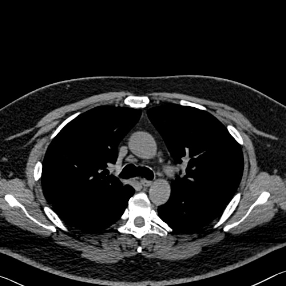 Adenoid cystic carcinoma of the trachea (Radiopaedia 49042-54137 Axial non-contrast 121).jpg