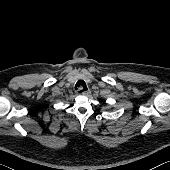 Adenoid cystic carcinoma of the trachea (Radiopaedia 49042-54137 Axial non-contrast 14).jpg