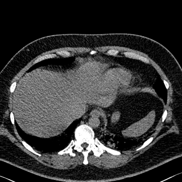 Adenoid cystic carcinoma of the trachea (Radiopaedia 49042-54137 Axial non-contrast 286).jpg