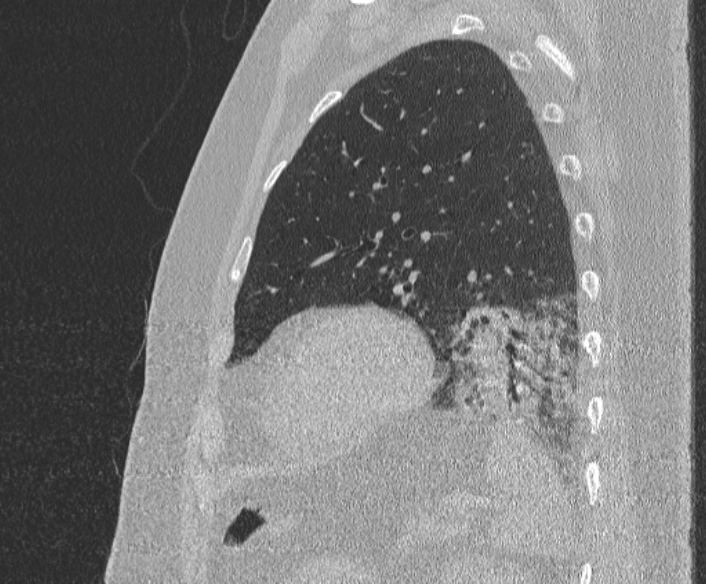 Adenoid cystic carcinoma of the trachea (Radiopaedia 49042-54137 Sagittal lung window 352).jpg