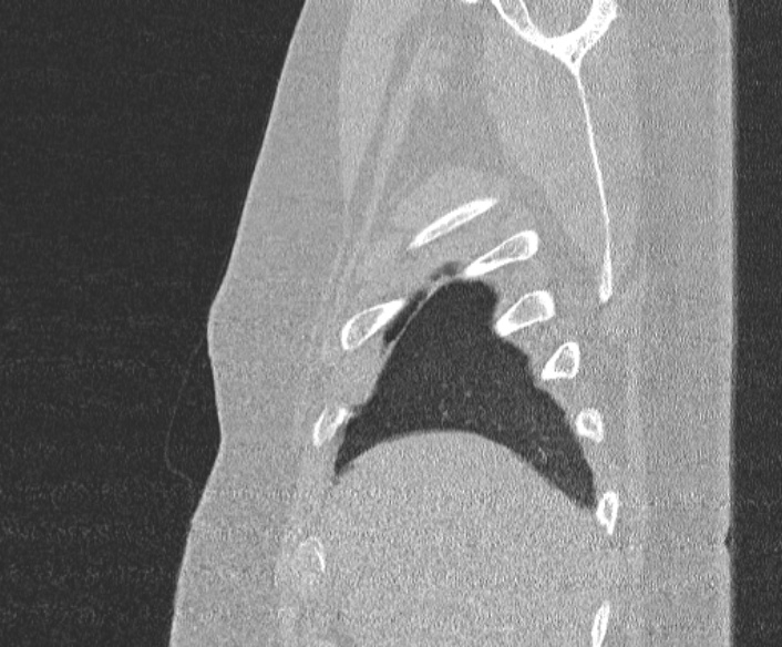 File:Adenoid cystic carcinoma of the trachea (Radiopaedia 49042-54137 Sagittal lung window 52).jpg