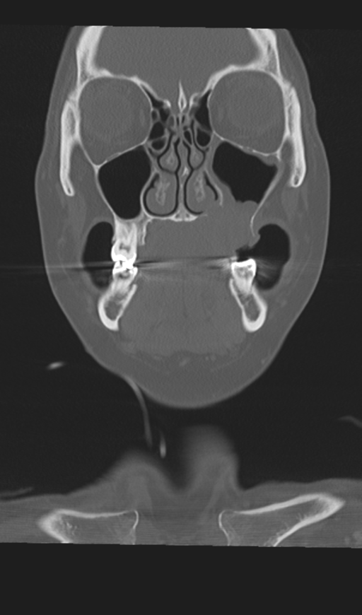 Adenoid cystic tumor of palate (Radiopaedia 46980-51518 Coronal bone window 21).png