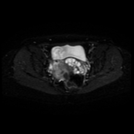 Adenoma malignum of cervix (Radiopaedia 66441-75705 Axial DWI 12).jpg