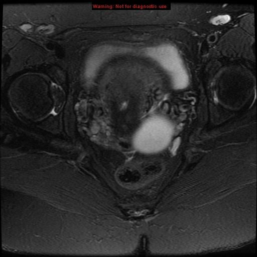 File:Adenomyosis (Radiopaedia 8972-9748 Axial T2 fat sat 9).jpg