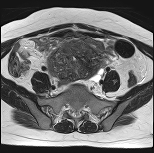 File:Adenomyosis - ovarian endometriomas (Radiopaedia 67031-76350 Axial T2 7).jpg
