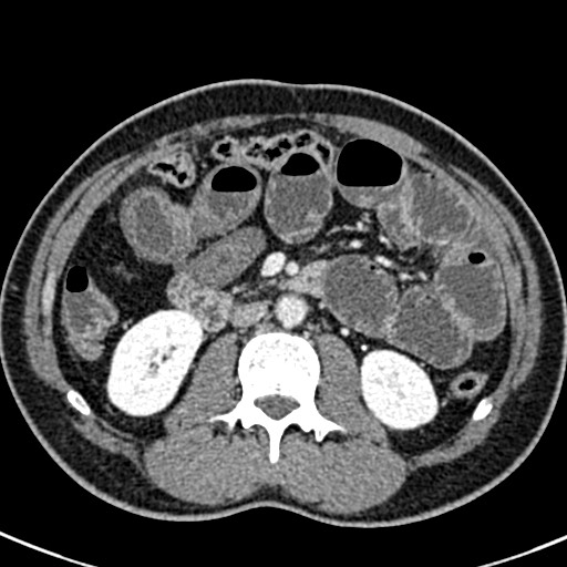 File:Adhesional small bowel obstruction (Radiopaedia 58900-66131 Axial C+ portal venous phase 23).jpg