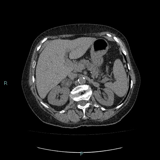 File:Adrenal collision tumor (ACT) (Radiopaedia 48462-53379 Axial non-contrast 16).jpg