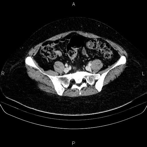 Adrenal cortical carcinoma (Radiopaedia 84882-100379 Axial C+ portal venous phase 70).jpg