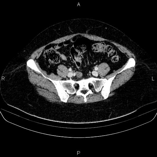 Adrenal cortical carcinoma (Radiopaedia 84882-100379 Axial C+ portal venous phase 71).jpg