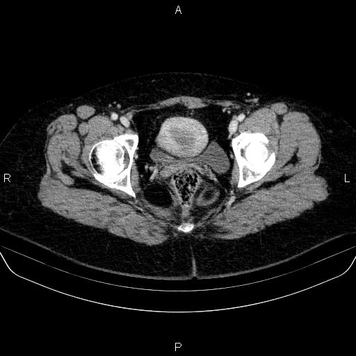 Adrenal cortical carcinoma (Radiopaedia 84882-100379 Axial C+ portal venous phase 91).jpg