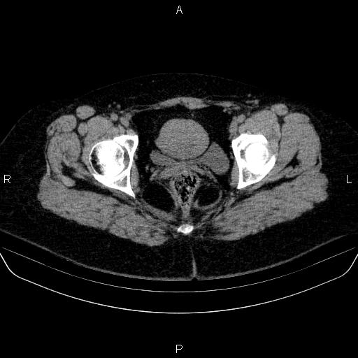 File:Adrenal cortical carcinoma (Radiopaedia 84882-100379 Axial non-contrast 91).jpg