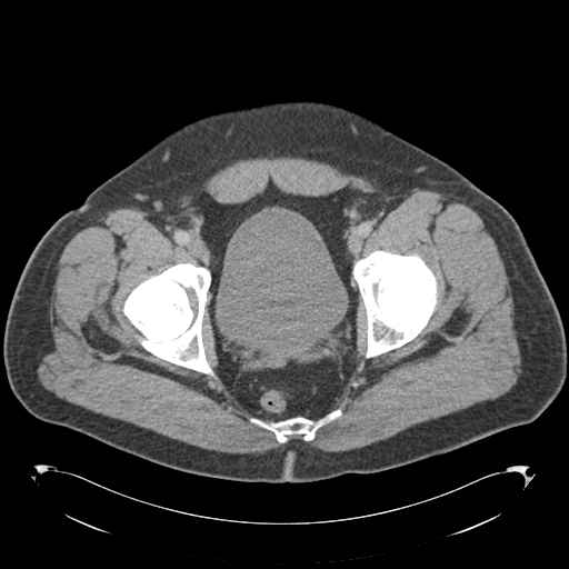 Adrenal cyst (Radiopaedia 45625-49776 Axial C+ portal venous phase 91).png