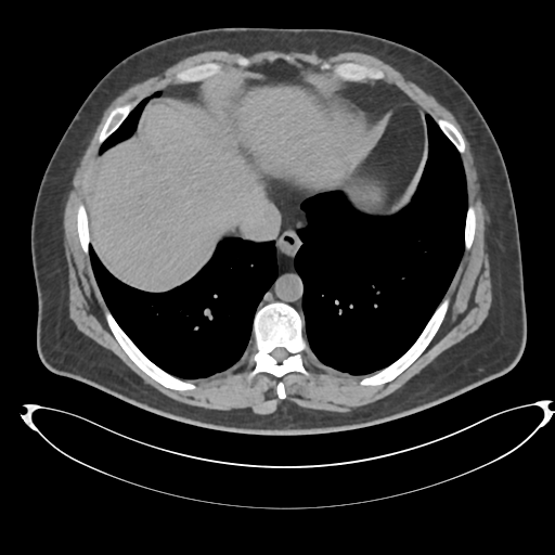 File:Adrenal cyst (Radiopaedia 45625-49778 Axial non-contrast 1).png