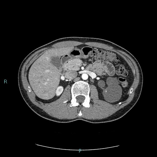 Adrenal cystic lymphangioma (Radiopaedia 83161-97534 Axial C+ arterial phase 35).jpg
