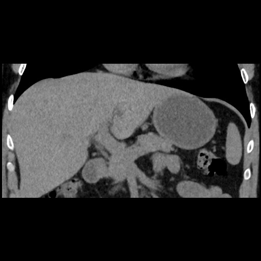Adrenal gland trauma (Radiopaedia 81351-95079 Coronal non-contrast 39).jpg