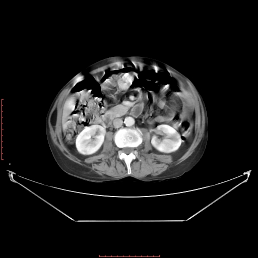 File:Adrenal hemangioma (Radiopaedia 68923-78668 Axial C+ portal venous phase 36).jpg