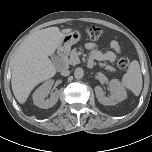 File:Adrenal hematoma (Radiopaedia 44334-47967 Axial non-contrast 35).png