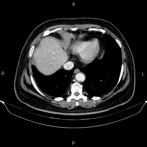 Adrenal hemorrhage (Radiopaedia 62622-70916 Axial C+ portal venous phase 11).jpg
