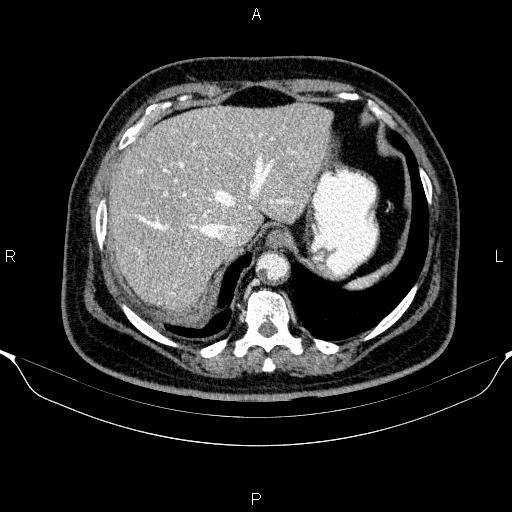 Adrenal hemorrhage (Radiopaedia 62622-70916 Axial C+ portal venous phase 23).jpg