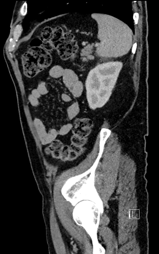 Adrenal lymphoma (Radiopaedia 73730-84529 Sagittal C+ portal venous phase 88).jpg