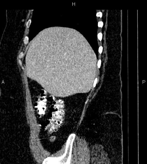 Adrenal myelolipoma (Radiopaedia 84319-99617 Sagittal renal cortical phase 15).jpg