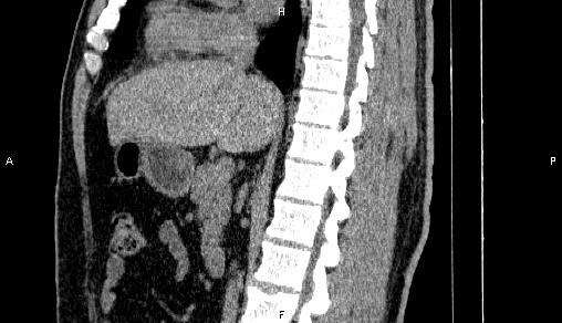 Adrenal myelolipoma (Radiopaedia 84321-99619 Sagittal non-contrast 52).jpg