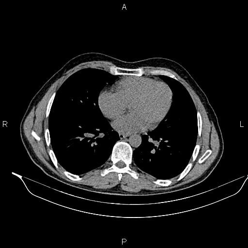Adrenal myelolipoma (Radiopaedia 87794-104246 Axial non-contrast 1).jpg