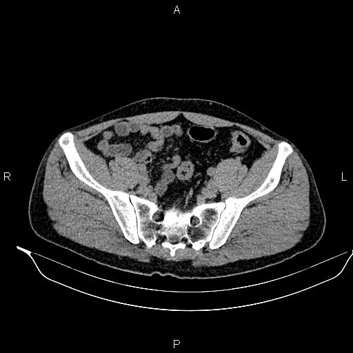 Adrenal myelolipoma (Radiopaedia 87794-104246 Axial non-contrast 84).jpg