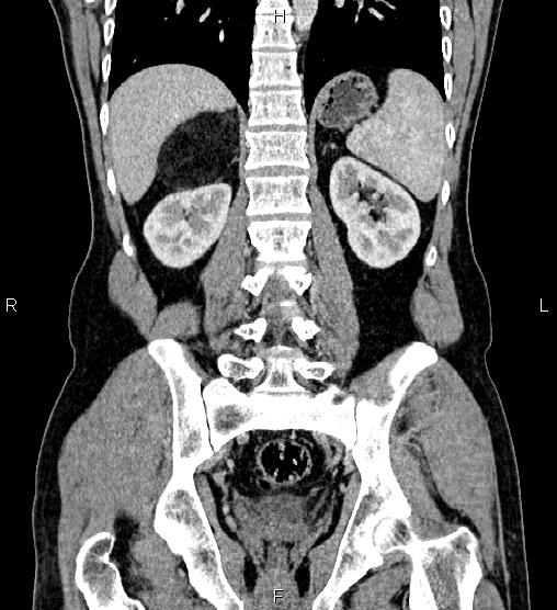 File:Adrenal myelolipoma (Radiopaedia 87794-104246 Coronal renal cortical phase 45).jpg