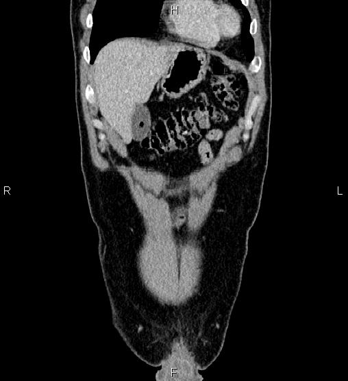 File:Adrenal myelolipoma (Radiopaedia 87794-104246 Coronal renal cortical phase 8).jpg