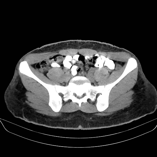 Adrenal myelolipoma - bilateral (Radiopaedia 74805-85810 Axial non-contrast 59).jpg