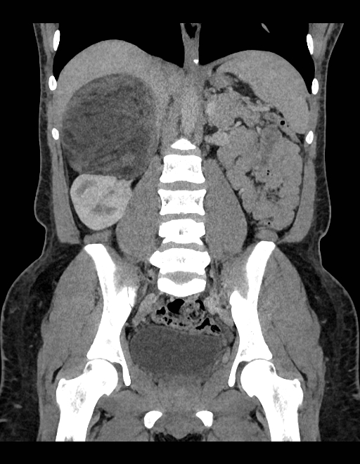 Adrenal myelolipoma - bilateral (Radiopaedia 74805-85810 Coronal C+ portal venous phase 135).jpg