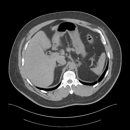 File:Adrenal vein sampling and adrenal nodular hyperplasia - Conn syndrome (Radiopaedia 30561-31337 Axial non-contrast 19).jpg