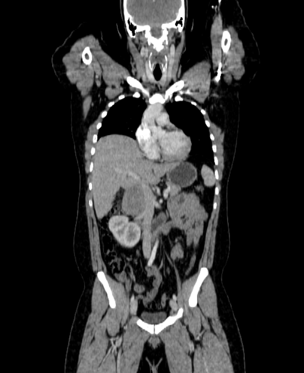 Adrenocortical carcinoma (Radiopaedia 80134-93438 Coronal C+ portal venous phase 74).jpg