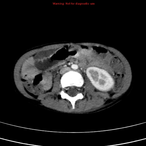File:Adrenocortical carcinoma (Radiopaedia 9449-10131 Axial C+ portal venous phase 32).jpg