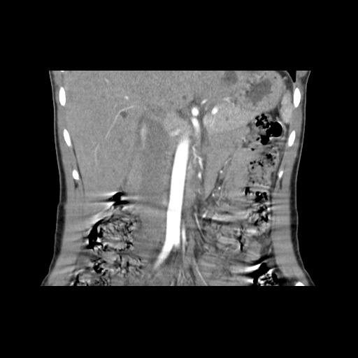 File:Adult polycystic kidney disease (Radiopaedia 48845-53876 Coronal renal cortical phase 15).jpg